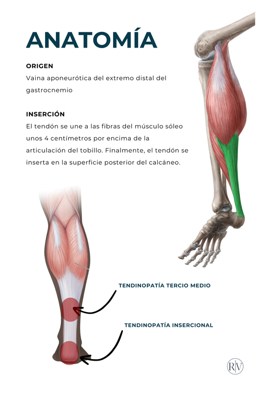 Tendón de Aquiles - Acaba con tu dolor en 12 semanas