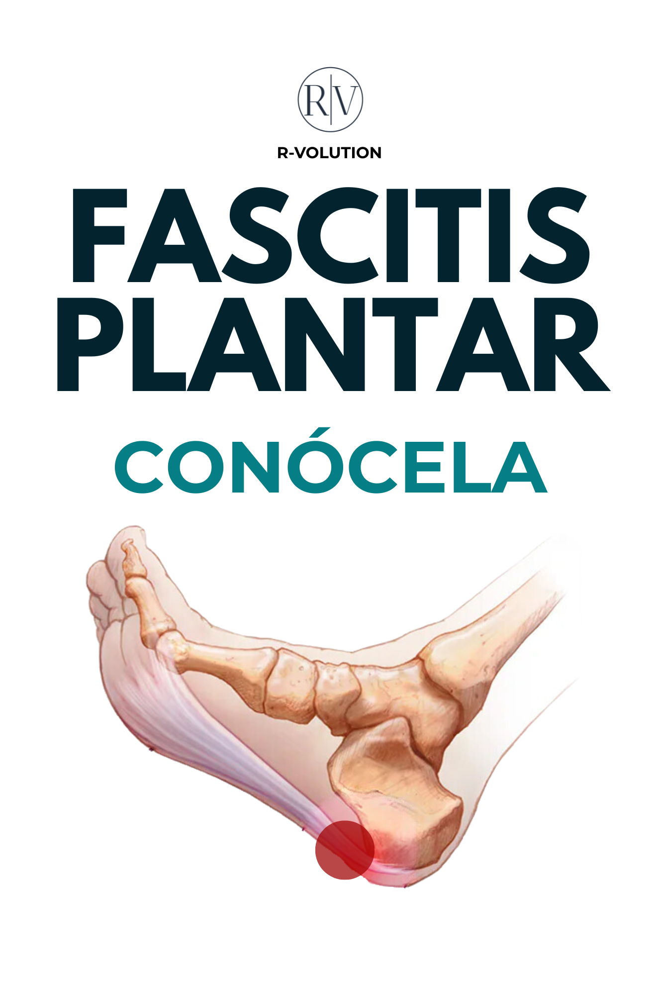 FASCITIS PLANTAR - CONÓCELA