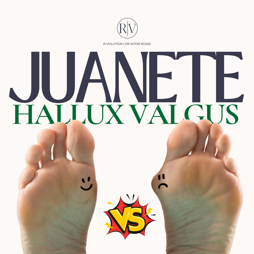 Juanete - Hallux Valgus
