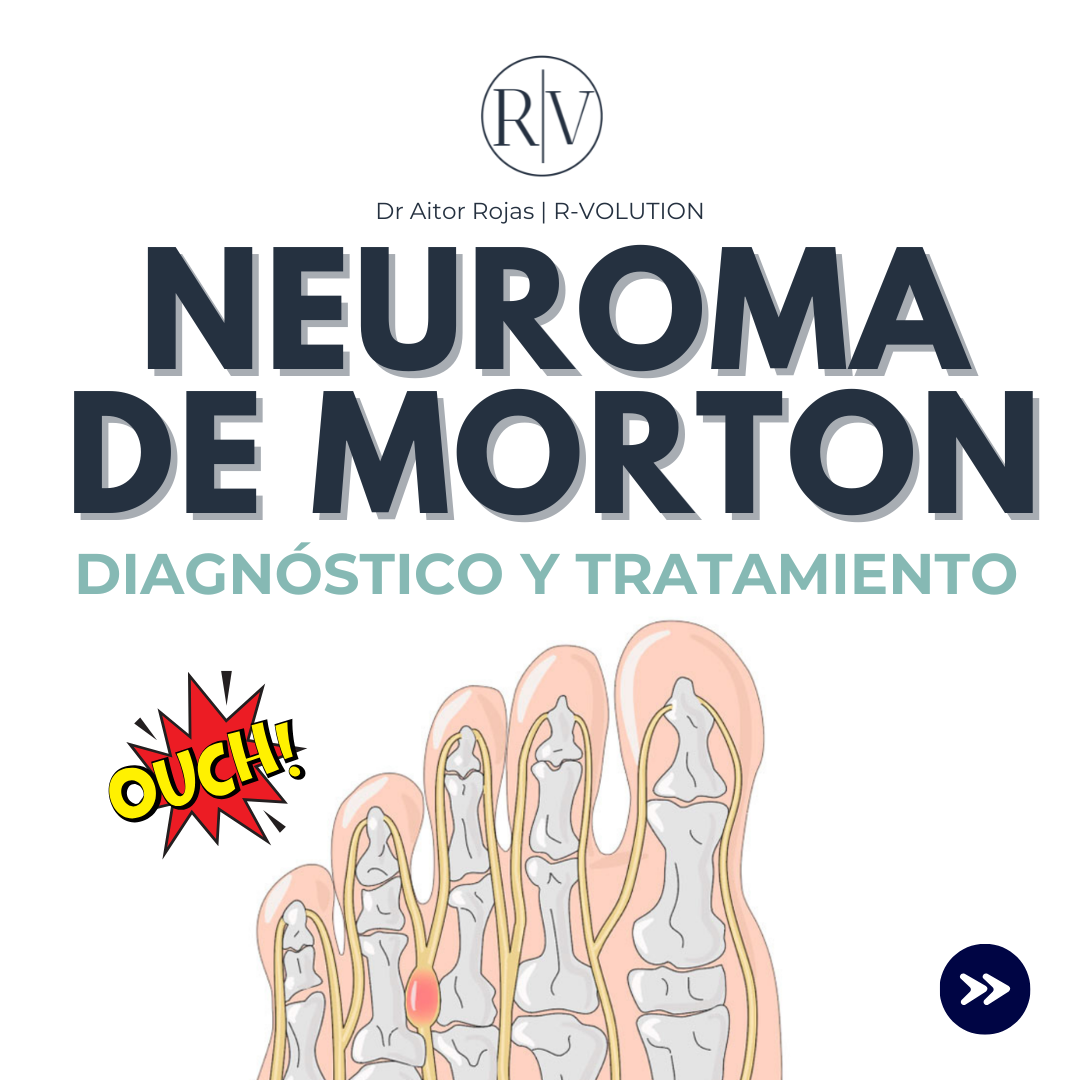 Neuroma de morton